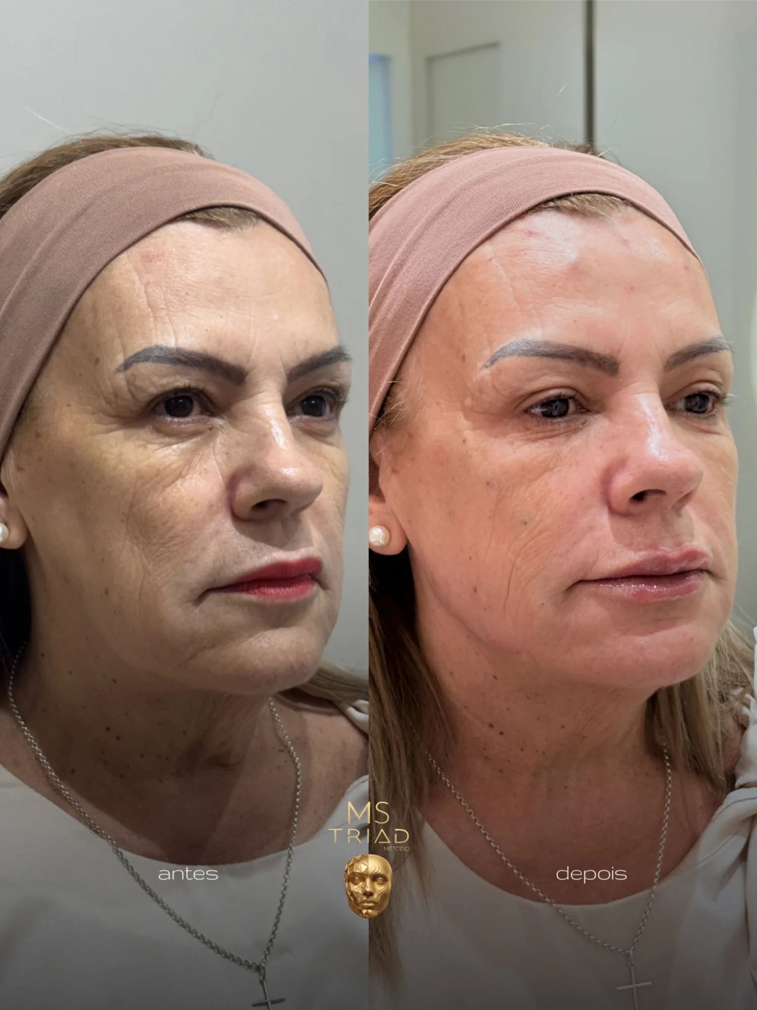 Comparação lado a lado de paciente do MS Triad®: mesma luz e mesmo ângulo, antes e depois do protocolo